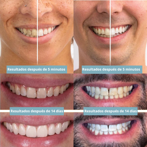 Lápiz Blanqueador Dental
